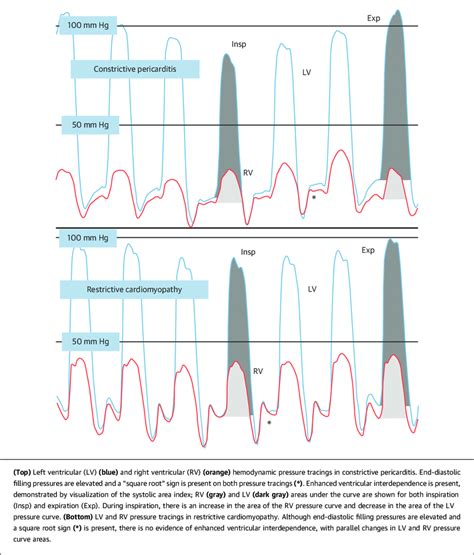 lv hemodynamics|normal hemodynamics catheterization.